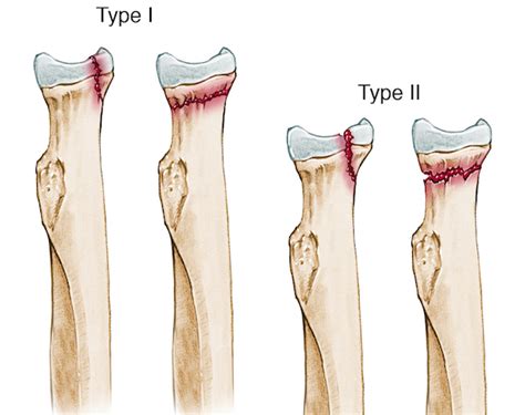 Radial head fracture