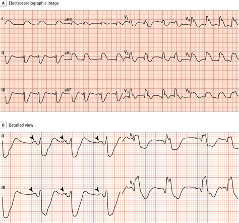 Qrs Complex Tachycardia In A Patient With Hemodynamic Instability | My ...