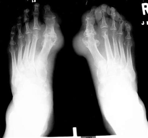 Radiological Charcot Arthropathy | Arthritis Research and Glucosamine ...