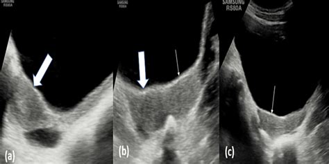 A Unique Case of Unicornuate Uterus With a Non-communicating Rudimentary Horn and Hematometra ...