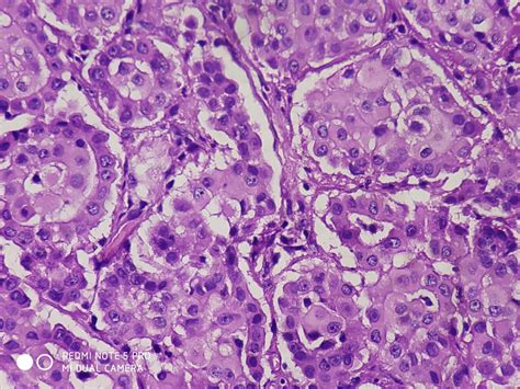 EPITHELIAL MALIGNANT MESOTHELIOMA – Histopathology.guru