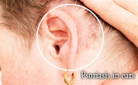 Psoriasis in ears – Causes, Symptoms & Treatment | Psoriasis expert