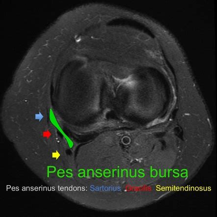 Pes anserine bursitis treatment - tidebe