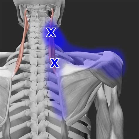 Acupuncture for Levator Scapulae Pain — Morningside Acupuncture NYC