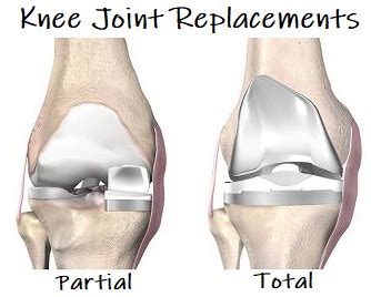 Knee Joint Replacement: Surgery & Recovery - Knee Pain Explained