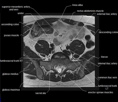 MRI pelvis Anatomy | Free Male Pelvis Axial Anatomy