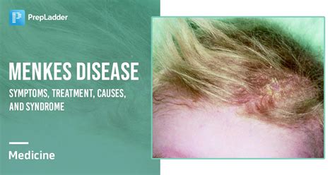 Menkes Disease Symptoms, Treatment, Causes, And Syndrome