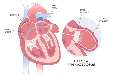 Left Atrial Appendage Closure (LAAC) - Auburn Cardiology Centre