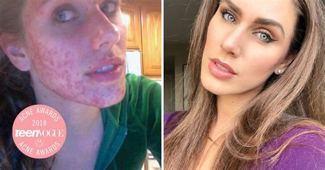 Cassandra Bankson on the Truth Behind Her Cystic Acne | Teen Vogue