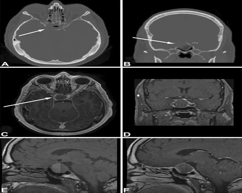 Afferent and Efferent Pupillary Defect With a Right Cranial ...