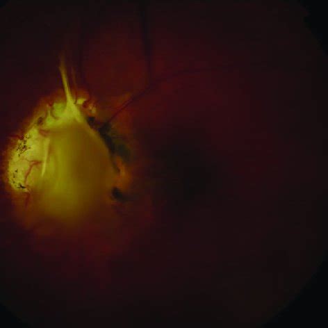 (PDF) Optic nerve avulsion: A case report