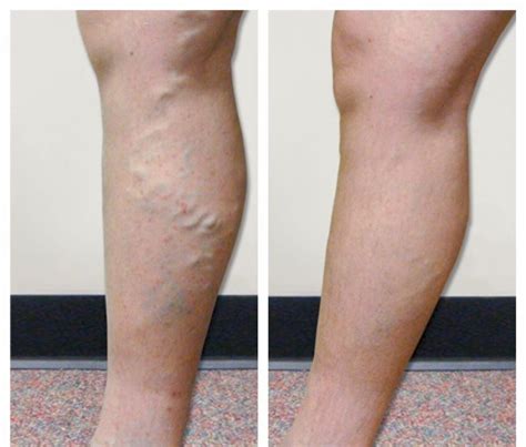 Varicose Veins - Disorders & Procedures - Vein Specialists of the Carolinas