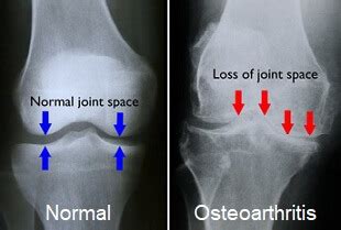 Arthritis in the Knee: Causes, Symptoms & Treatment