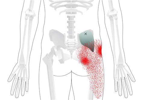 Gluteus Medius Trigger Points (Overview - Self Treatment Tips)