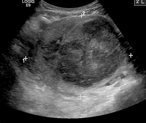 Transvaginal Ultrasound Fibroids