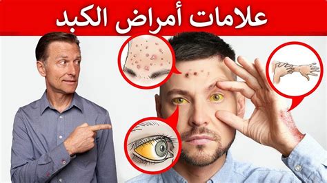 ١٥ علامة في الجلد تخبركم عن أمراض الكبد وماهو أفضل طعام للكبد - YouTube