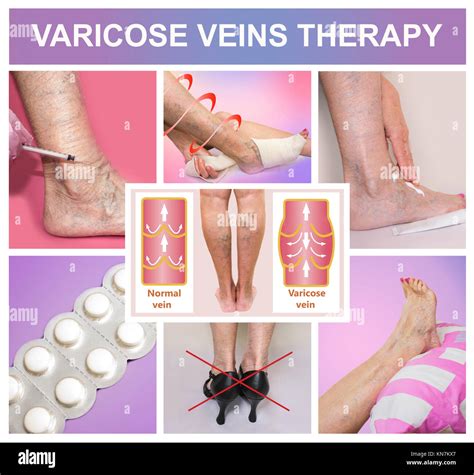 Treatment of varicose veins Stock Photo - Alamy