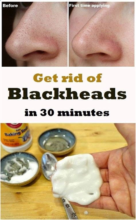 Remove Blackheads in 30 minutes | Blackhead remedies