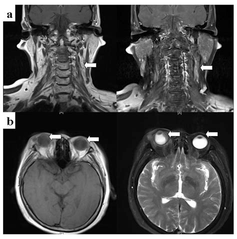 Multiple myeloma with extramedullary plasmacytoma invading the skin and eyeballs following ...