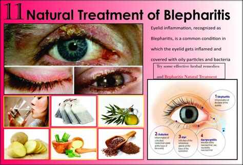 11 Best Natural Treatments of Blepharitis - Herbs Solutions By Nature