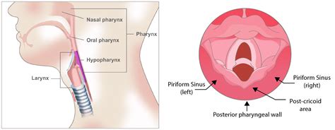 Hypopharyngeal Cancer | Affiliated Oncologists