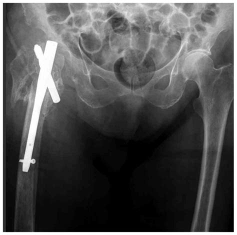 A new perspective towards failure of gamma nail systems