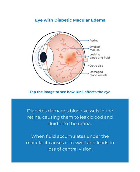 DME - Diabetic Macular Edema - Kodiak Sciences