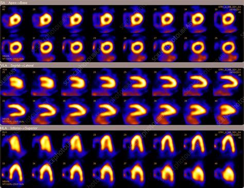 Healthy heart muscle, SPECT scan - Stock Image - C013/1038 - Science Photo Library