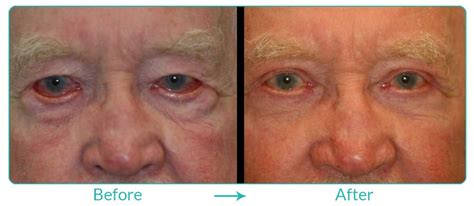 Ectropion Eyelid Repair | Best Blepharoplasty in California | Eyesthetica