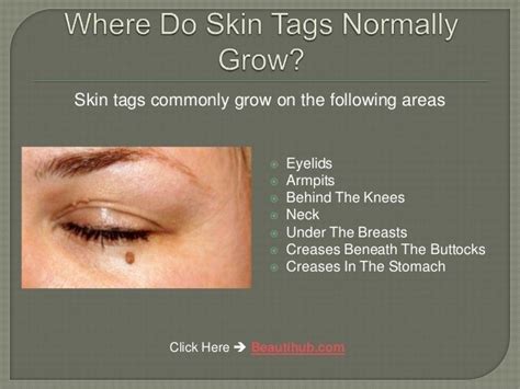 Skin Tag On Eyelid Pictures - update berita olahraga dalam luar