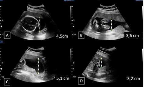 Automated Ultrasound Assessment Of Amniotic Fluid Index, 40% OFF