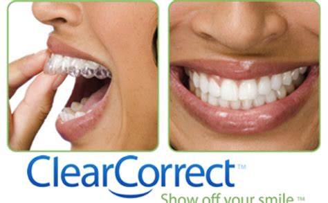 5 Reasons to Consider ClearCorrect: The Braces Alternative - The Dental ...