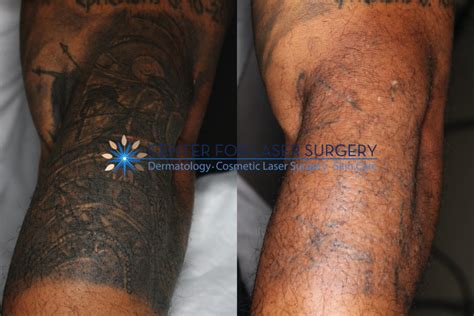 versapulse laser tattoo removal - shannon-dobrushin