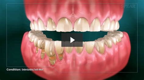 Understanding Tooth Wear - Cosmetic Dentistry