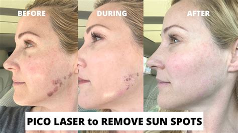Pico Laser Treatment to Remove Sun Spots Before and After | With Dr ...