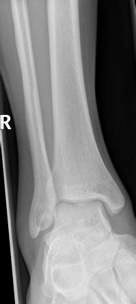 Ankle (mortise view) | Radiology Reference Article | Radiopaedia.org