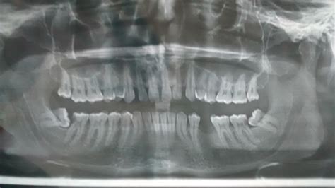 dentistry - Minimum treatment needed as per my full mouth xray - Health Stack Exchange