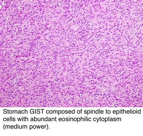 Pathology Outlines - GIST