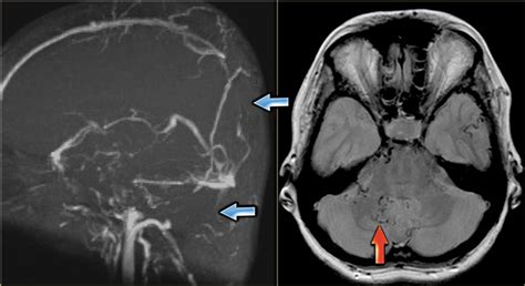 Dural Venous Thrombosis