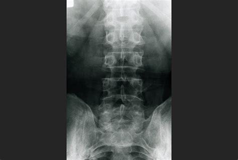 Axial Psoriatic Arthritis and Ankylosing Spondylitis: Comparing Clinical, Radiologic ...