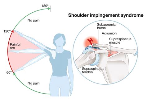 Shoulder Impingement Syndrome – First Choice Physical Therapy