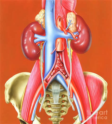 Saddle Embolus At Aortic Bifurcation Photograph by John Bavosi/science Photo Library | Pixels