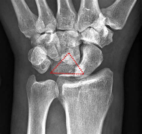 Scaphoid Bone Definition Location Anatomy Diagram The - vrogue.co