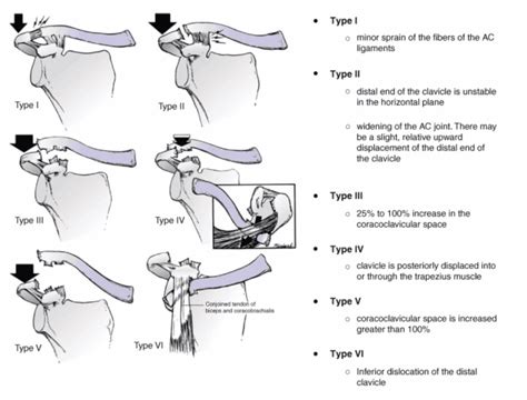 Ac Joint Types