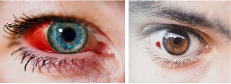 SUBCONJUNCTIVAL HEMORRHAGE – Cypress Eye Centre