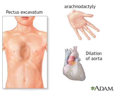 Marfan syndrome Information | Mount Sinai - New York