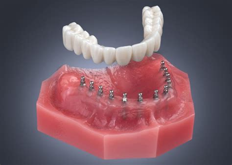 Mini Dentures in Butler, PA | Dental Implants | Tooth Replacement