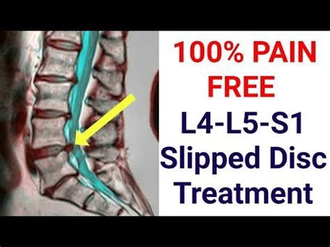 L4-L5-S1 Slipped Disc Treatment - 3 Stage Program To Completely Cure SLIPPED DISC -100 % PAIN ...