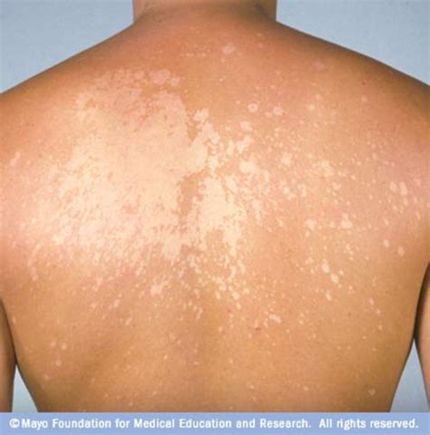 Tinea Versicolor - Symptoms & Treatments Like Selsun Blue