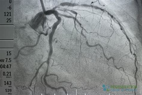 Stem Cell Therapy for Heart Disease Atherosclerosis CAD IHD